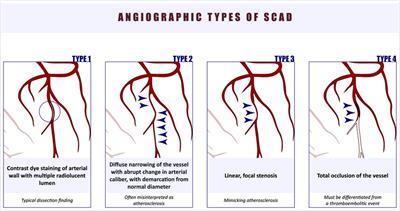Pathophysiology of spontaneous coronary artery dissection: hematoma, not thrombus